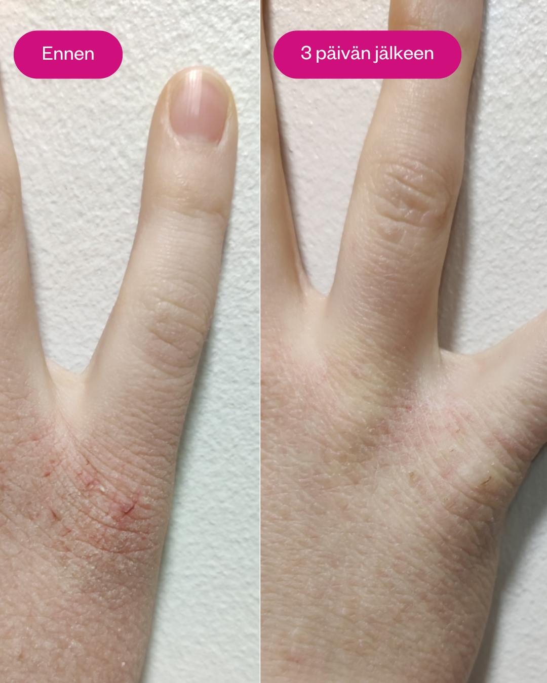 FLOW Cosmetics Propolis & Probiotics Rescue Cream; kaksi valokuvaa käden selkäpuolesta; vasemmassa kuvassa iho punoittava, kuiva ja halkeillut, oikeassa sama käsi kolmen päivän jälkeen näkyvästi sileämpänä ja vähemmän ärtyneenä; molemmissa kuvissa neutraali valaistus ja tasainen tausta; ei näkyvää pakkausta tai tekstiä; kuvattu läheltä ylhäältäpäin.