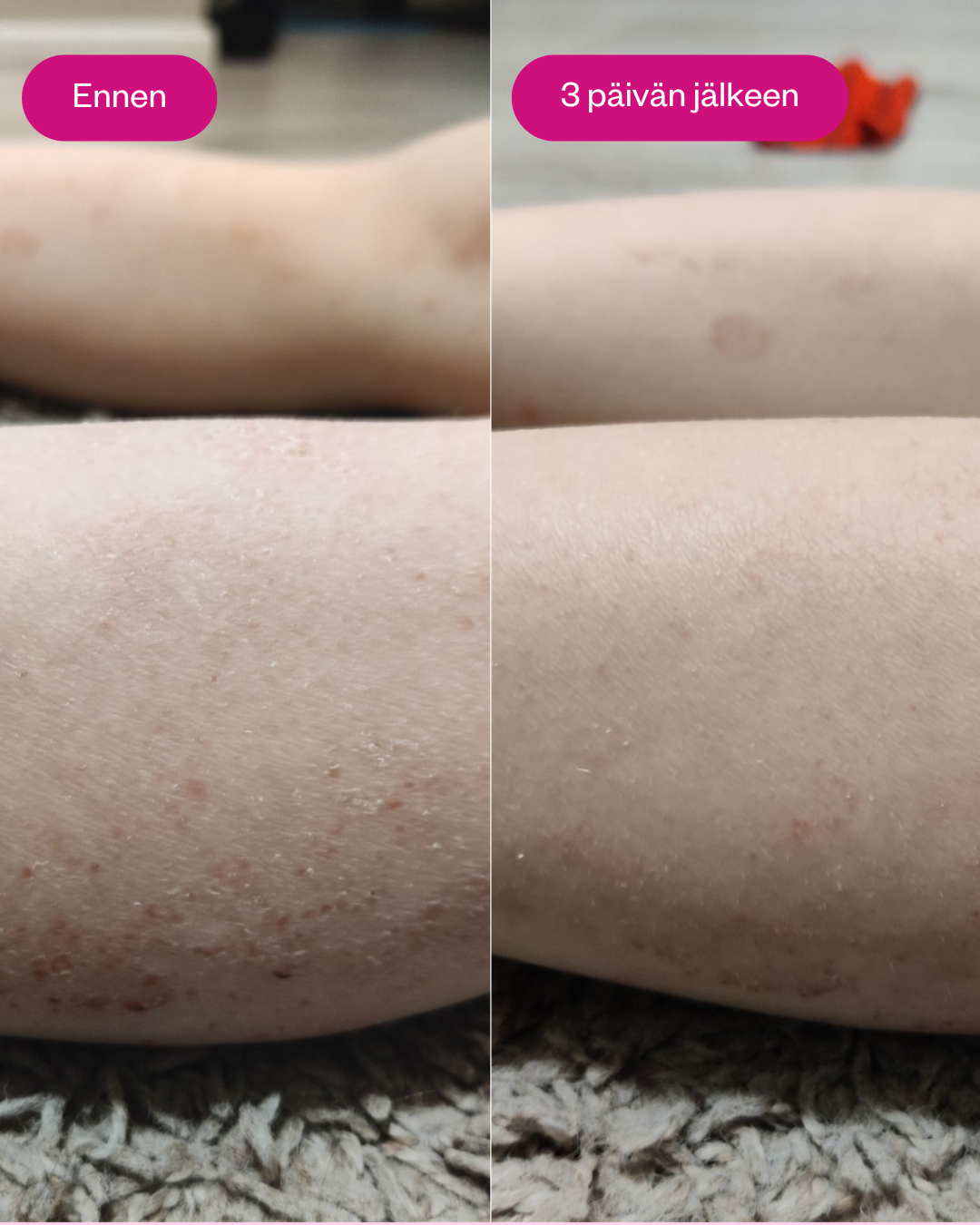 FLOW Cosmetics Propolis & Probiotics Rescue Cream; lähikuva henkilön alaraajoista rinnakkaisvertailussa; vasen sääri kuiva ja punaisin täplin (merkintä Ennen), oikea sääri näyttää sileämmältä ja vähäläikkäisemmältä (merkintä 3 päivän jälkeen); molemmat säären osat lepäävät pehmeällä matolla.