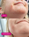 FLOW Cosmetics Propolis & Probiotics Rescue Cream; lähikuva lapsen leuasta, yläkuvassa punaisia täpliä ja ärsytystä merkinnällä Ennen, alakuvassa selvästi sileämpi ja kirkkaampi iho merkinnällä 3 päivän jälkeen; molemmat kuvat tiiviisti rajattuja; tausta epätarkka ja neutraalinvärinen; valkoiset tekstimerkinnät mustalla ääriviivalla kummassakin kuvassa, ei näkyvää pakkausta tai tuotteita.